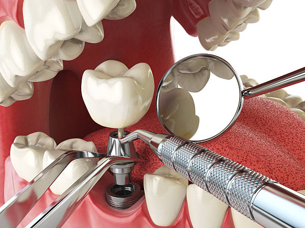 Best Emergency Root Canal Treatment in Baltimore, MD
